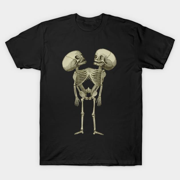 ★SURGERY★ siamese twin type-1 T-shirts Siamese Twins Skeleton - Siamese - T-Shirt | TeePublic
